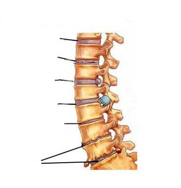 Como se desenvolve a osteocondrose