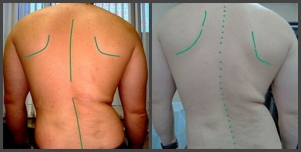 curvatura da columna vertebral con osteocondrose