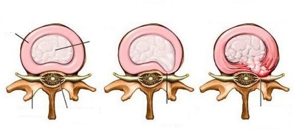 hernia intervertebral con osteocondrose cervical