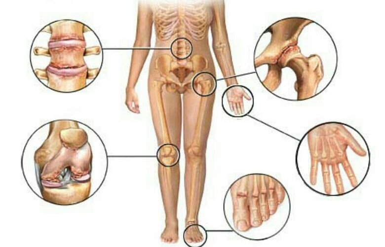 Tipos e graos de artrose