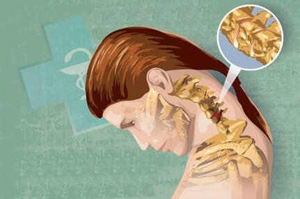 Síntomas reflexos de osteocondrose